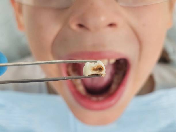 Best Emergency Treatment for Dental Infections or Abscesses in Shelbina, MO